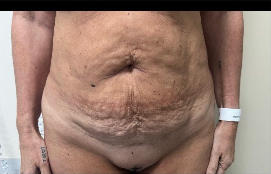 Abdomen flácido con diástasis antes de la abdominoplastia