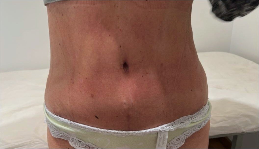 Abdomen plano a los 30 días de la abdominoplastia