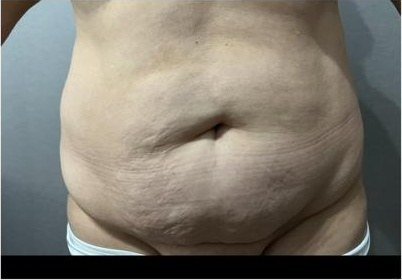 Abdomen con exceso de piel y grasa antes de la abdominoplastia