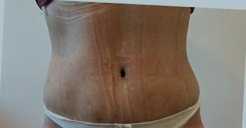 Cintura definida a los 35 días de la abdominoplastia