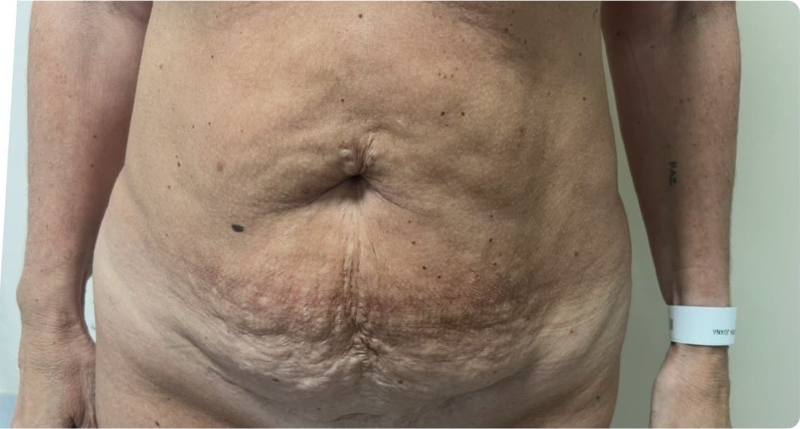 Abdomen muy flácido con diástasis y hernia umbilical antes de la abdominoplastia