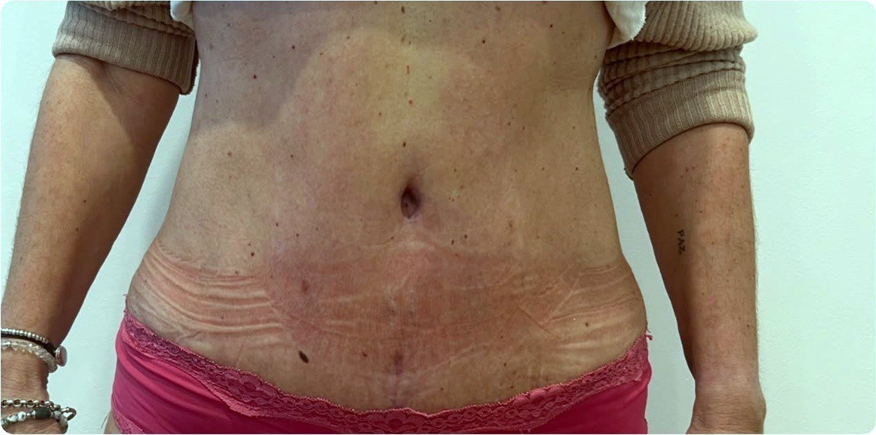 Abdomen plano 40 días después de la abdominoplastia, de frente