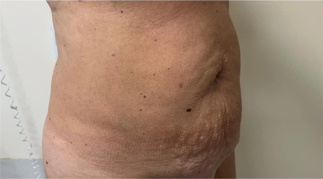 Perfil oblicuo del abdomen antes de la abdominoplastia