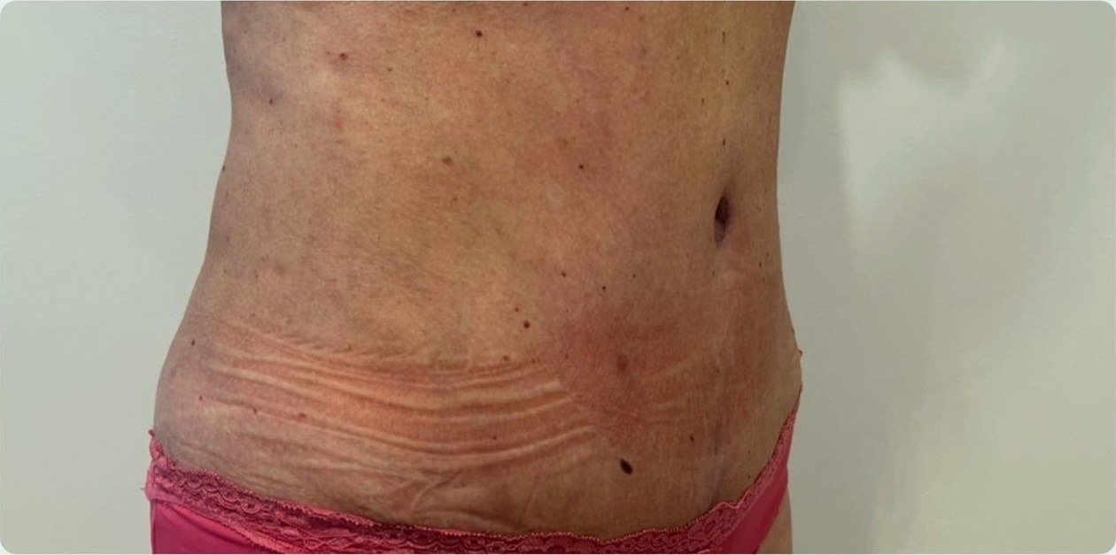 Perfil oblicuo 40 días después de la abdominoplastia