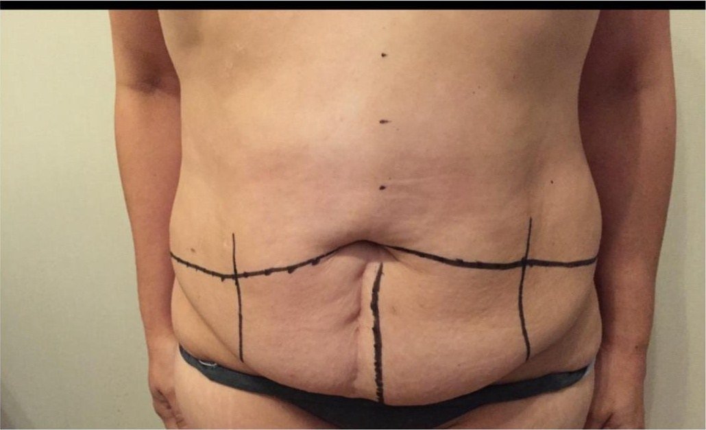 Marcación preoperatoria de abdominoplastia con exceso de piel abdominal