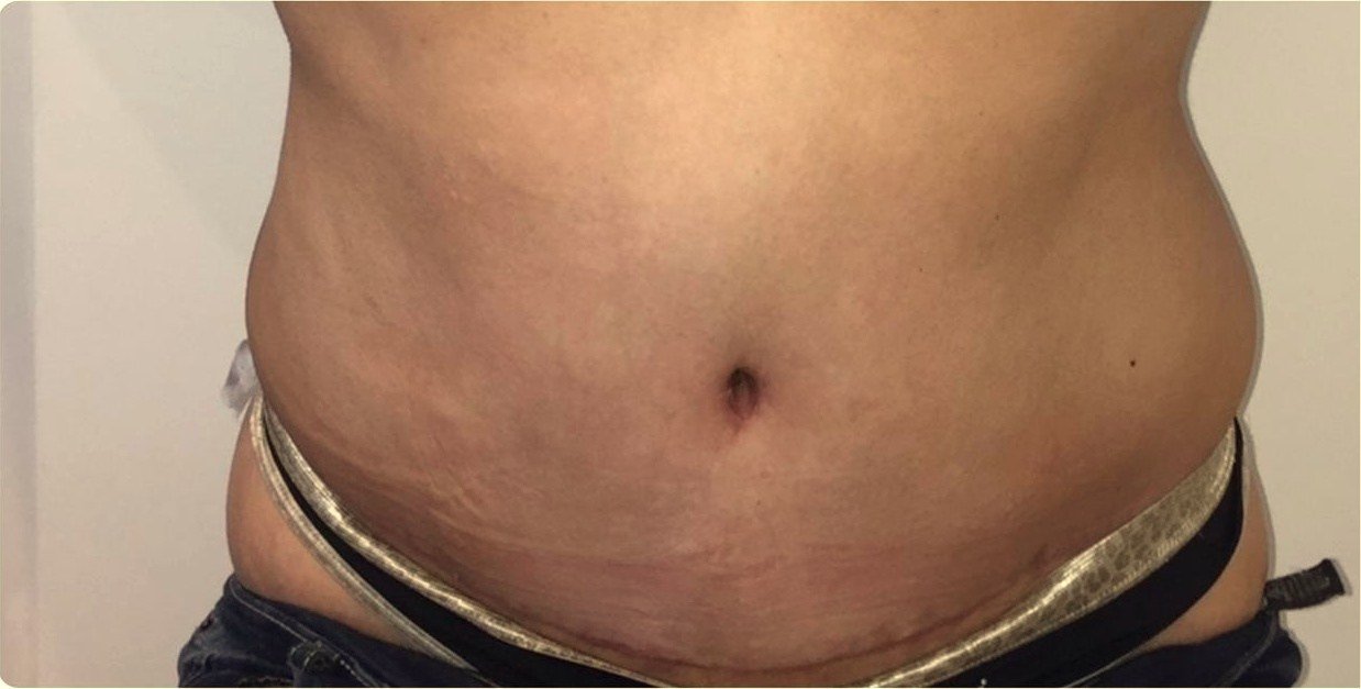 Cicatriz de abdominoplastia a los 45 días, oculta bajo la ropa interior