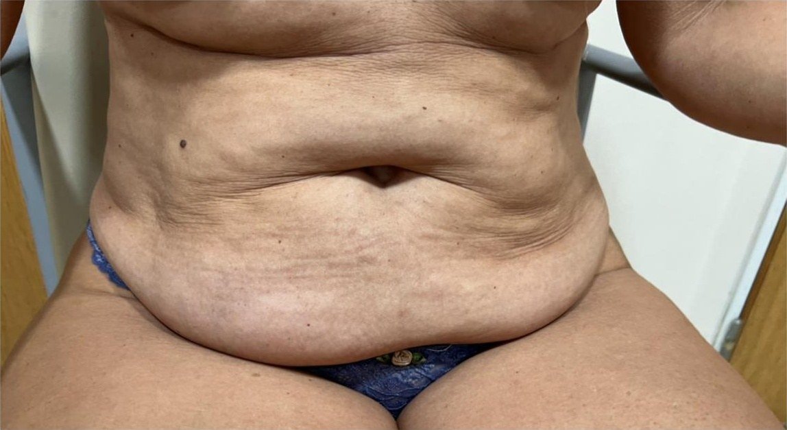 Abdomen con diástasis y exceso de piel antes de la abdominoplastia, paciente sentada