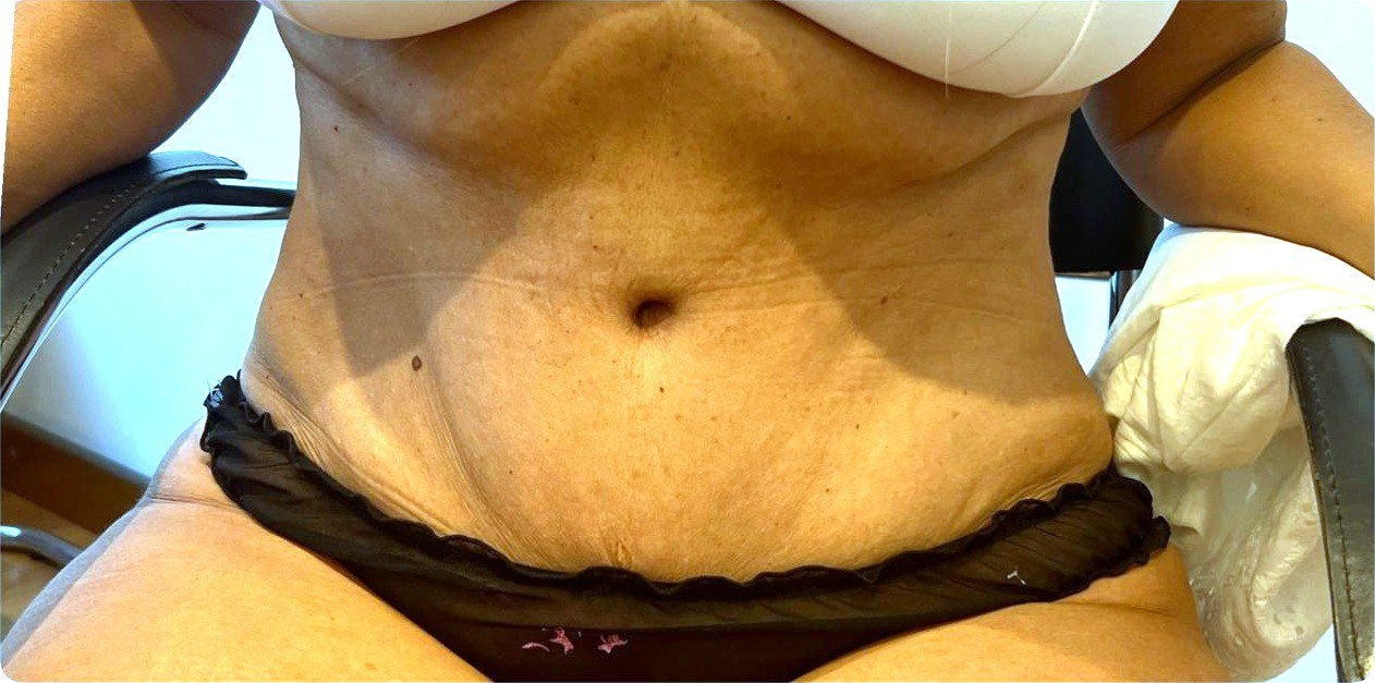Abdomen a los 60 días de la abdominoplastia con lipoescultura de flancos, sentada