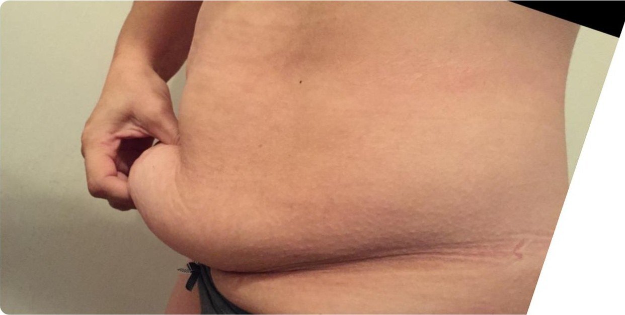 Paciente pinzando con la mano el excedente de piel y grasa del abdomen