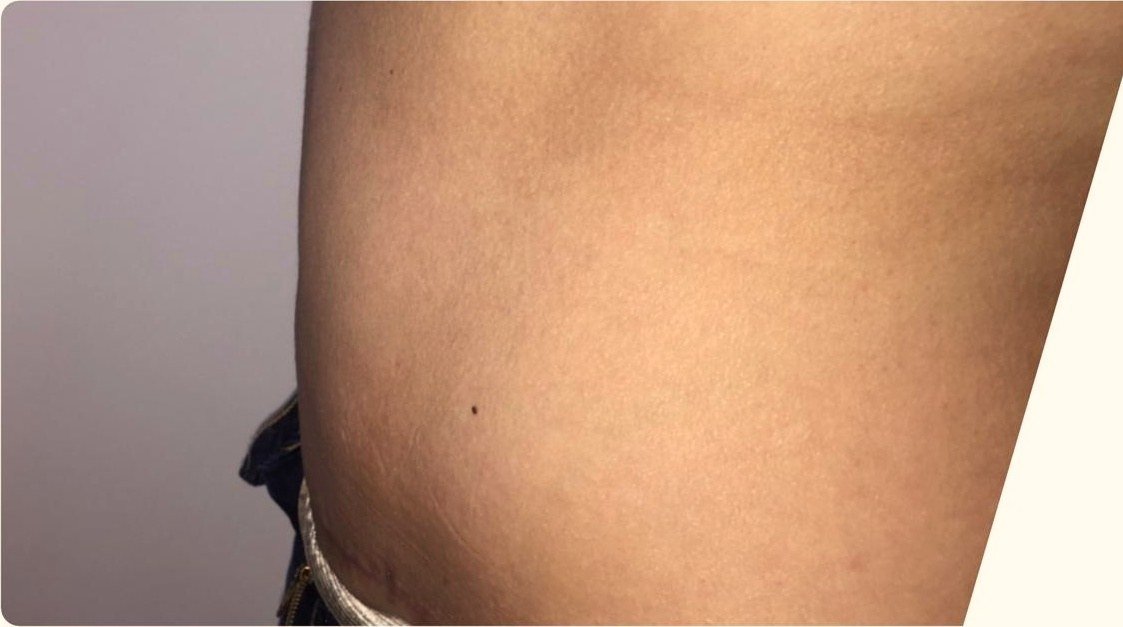 Perfil del abdomen 45 días después de la abdominoplastia