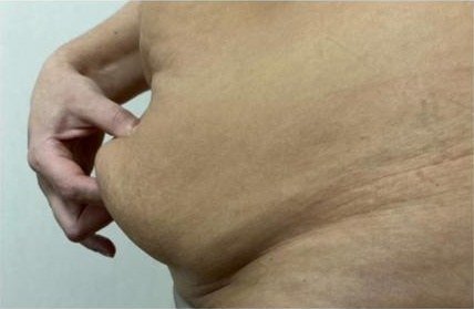 Excedente de piel abdominal pinzado con la mano antes de la cirugía
