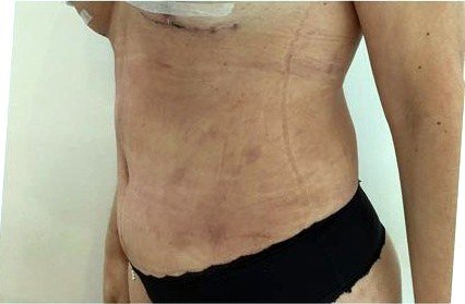 Perfil del abdomen a los 9 días de la abdominoplastia