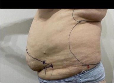 Perfil del abdomen con marcación antes de abdominoplastia con liposucción