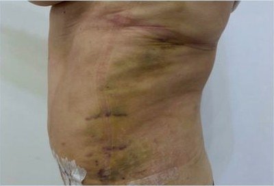 Hematomas normales a los 7 días de una abdominoplastia con lipo