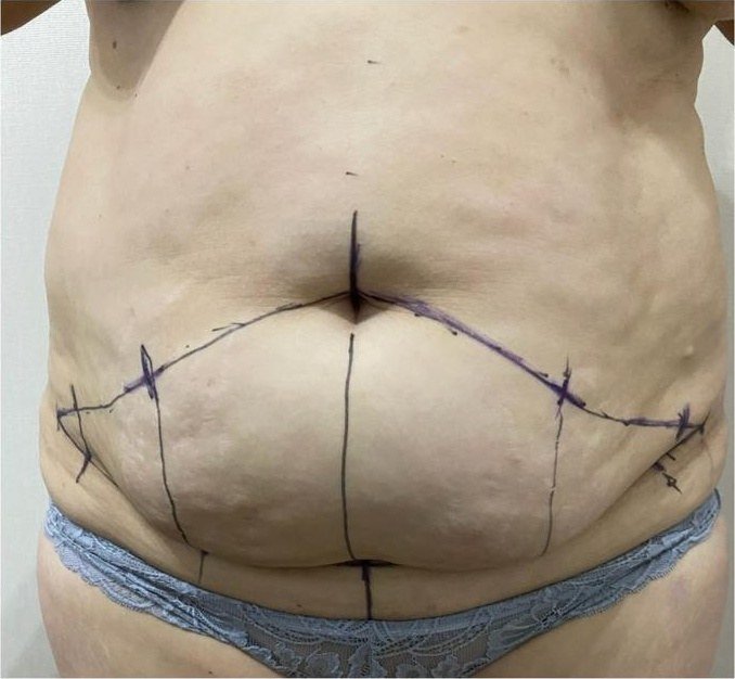 Marcación azul preoperatoria de abdominoplastia sobre el abdomen