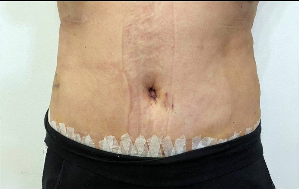 Resultado de abdominoplastia a los 9 días con cintas quirúrgicas