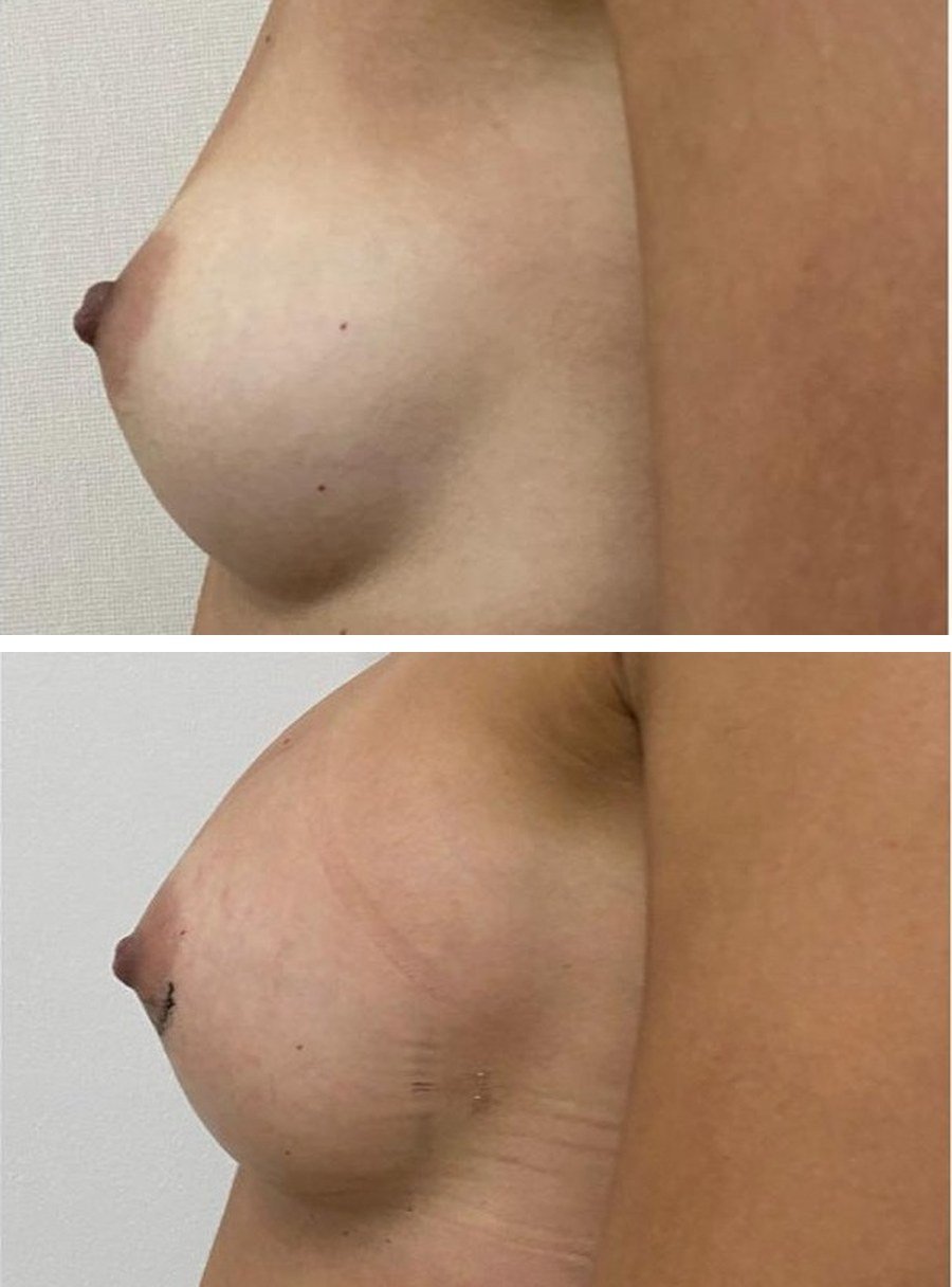 Aumento mamario de perfil antes y despues: proyección con prótesis