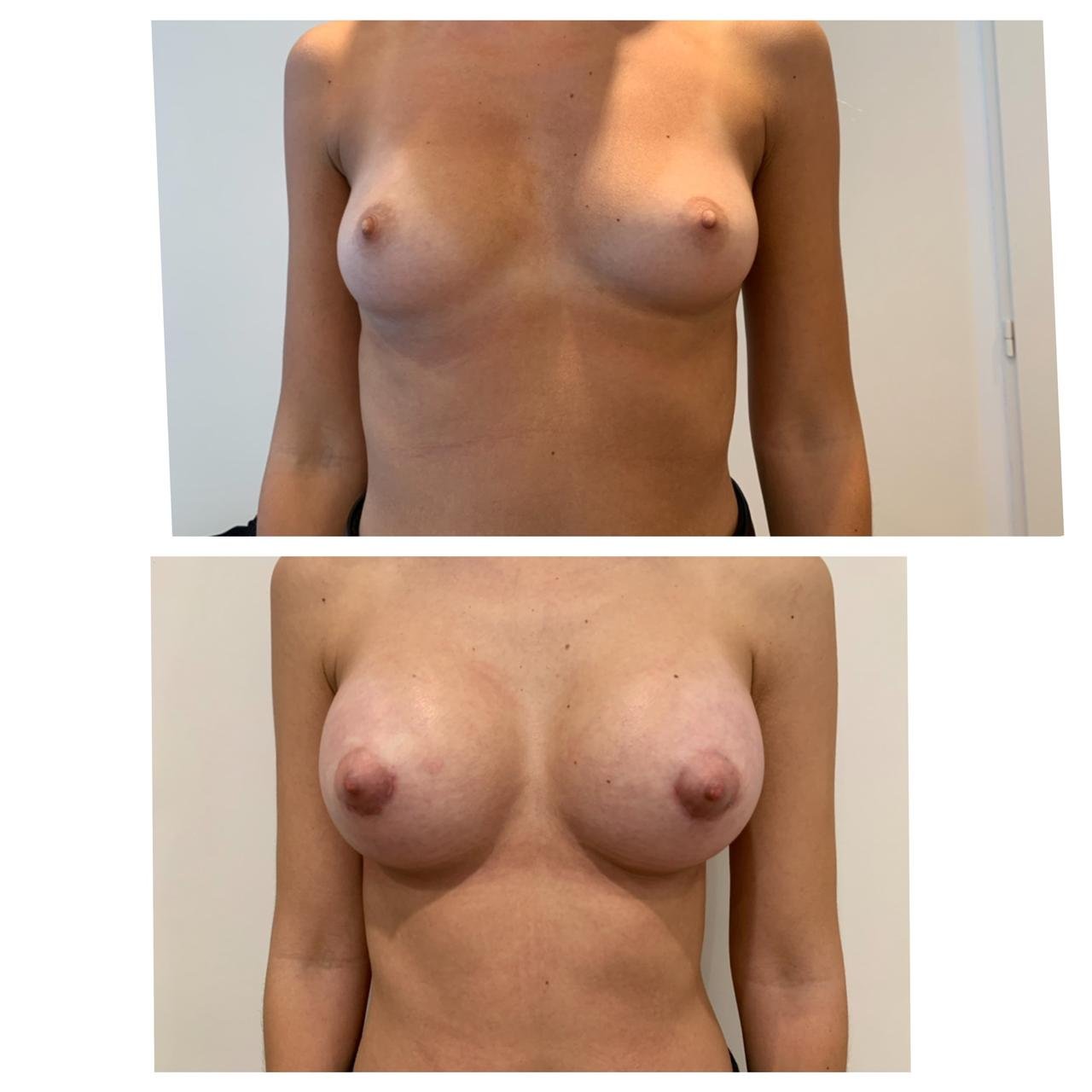 Aumento mamario con prótesis antes y despues