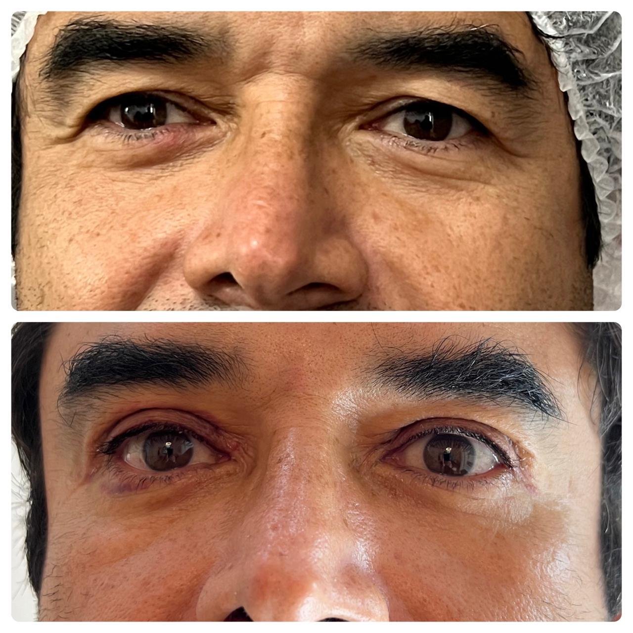 Blefaroplastia masculina antes y después - cirugía de párpados en hombres en Buenos Aires
