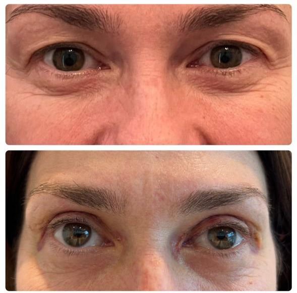 Rejuvenecimiento femenino completo con blefaroplastia superior e inferior