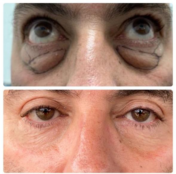 Bolsas en los ojos antes y después - eliminación de bolsas palpebrales en Buenos Aires