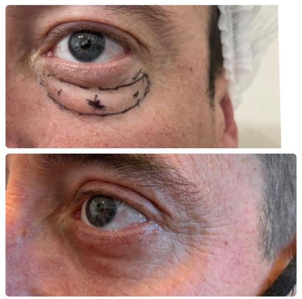 Perfil paciente masculino post blefaroplastia inferior