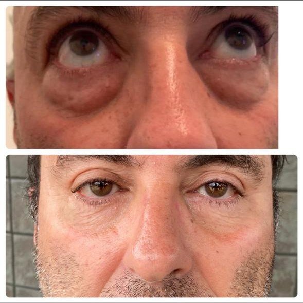 Cirugía de bolsas en los ojos antes y después - blefaroplastia inferior en hombre en Buenos Aires