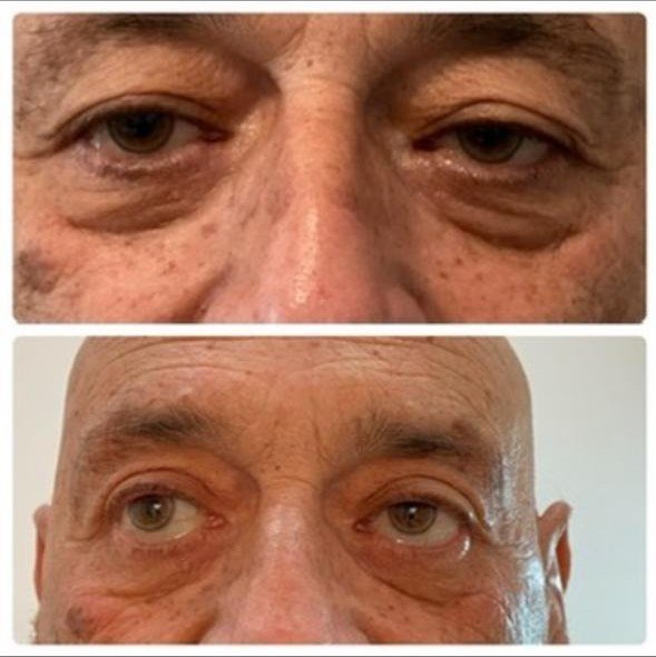 Blefaroplastia antes y después - corrección de bolsas y flacidez palpebral en paciente masculino en Buenos Aires
