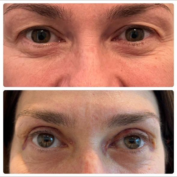 Blefaroplastia inferior antes y después - corrección de bolsas en los ojos en mujer en Buenos Aires