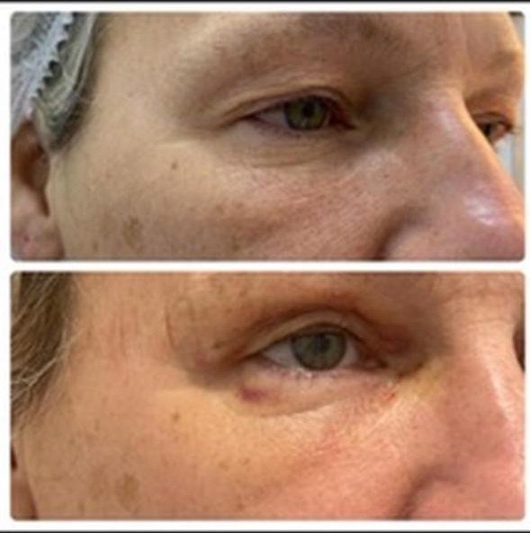 Blefaroplastia inferior antes y después - vista de perfil del contorno del párpado en mujer en Buenos Aires