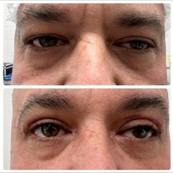 Blefaroplastia masculina antes y después - cirugía de párpados superior e inferior en hombre en Buenos Aires