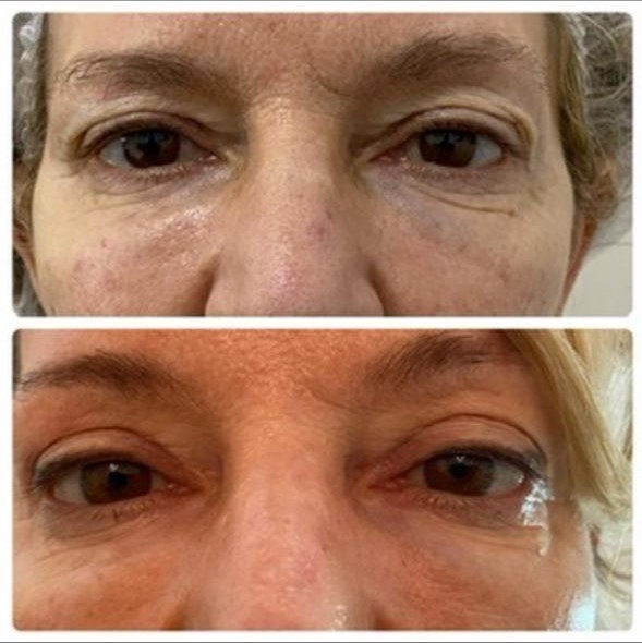 Blefaroplastia superior e inferior antes y después - rejuvenecimiento de la mirada en mujer en Buenos Aires