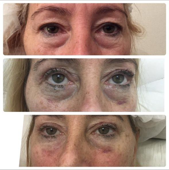 Evolución del postoperatorio de blefaroplastia - antes y después en mujer en Buenos Aires