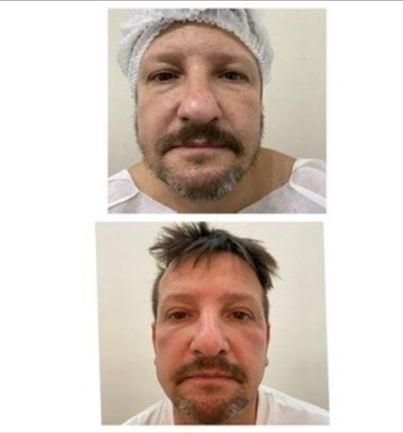 Blefaroplastia masculina antes y después - rostro completo, rejuvenecimiento de la mirada en hombre en Buenos Aires