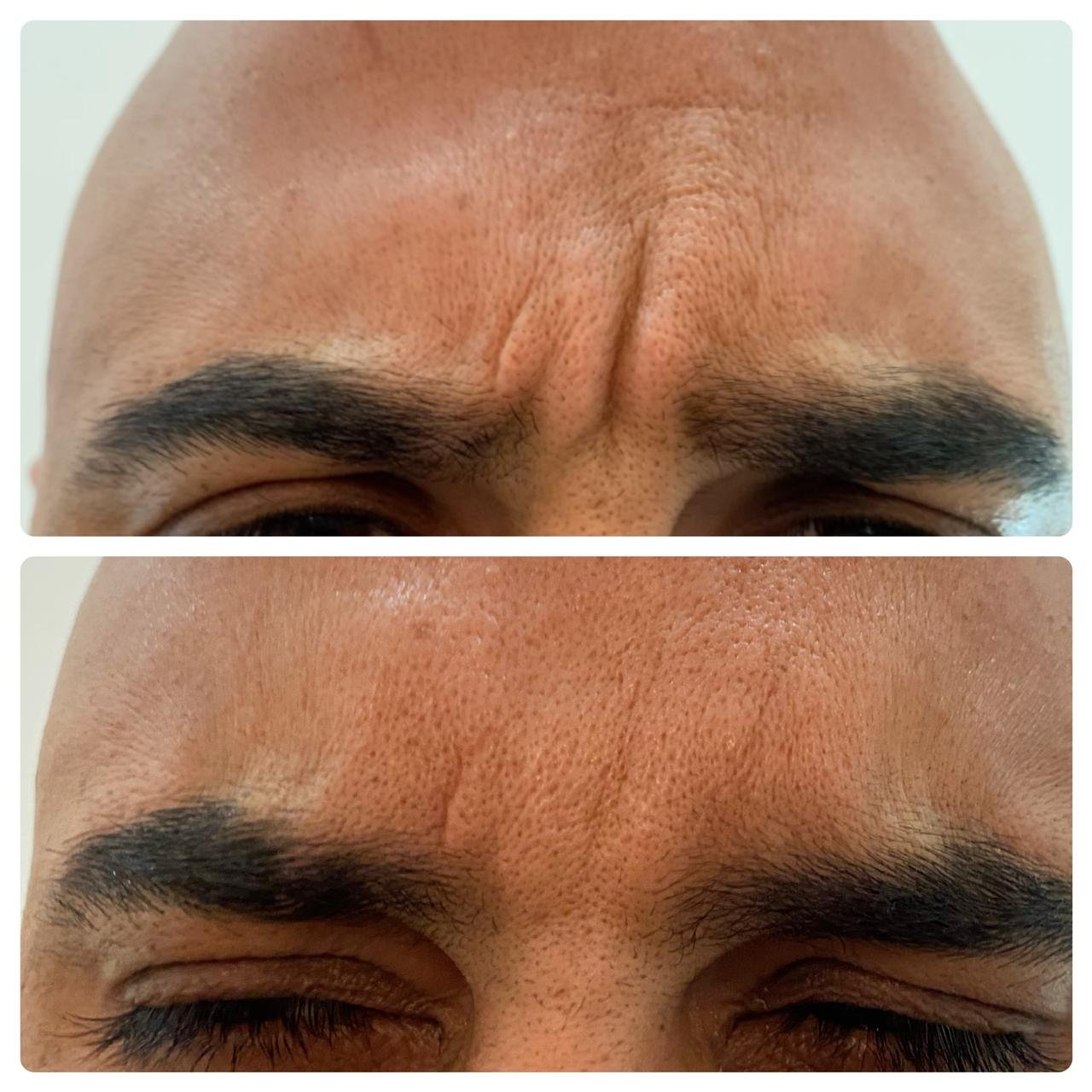 Relajación del músculo corrugador