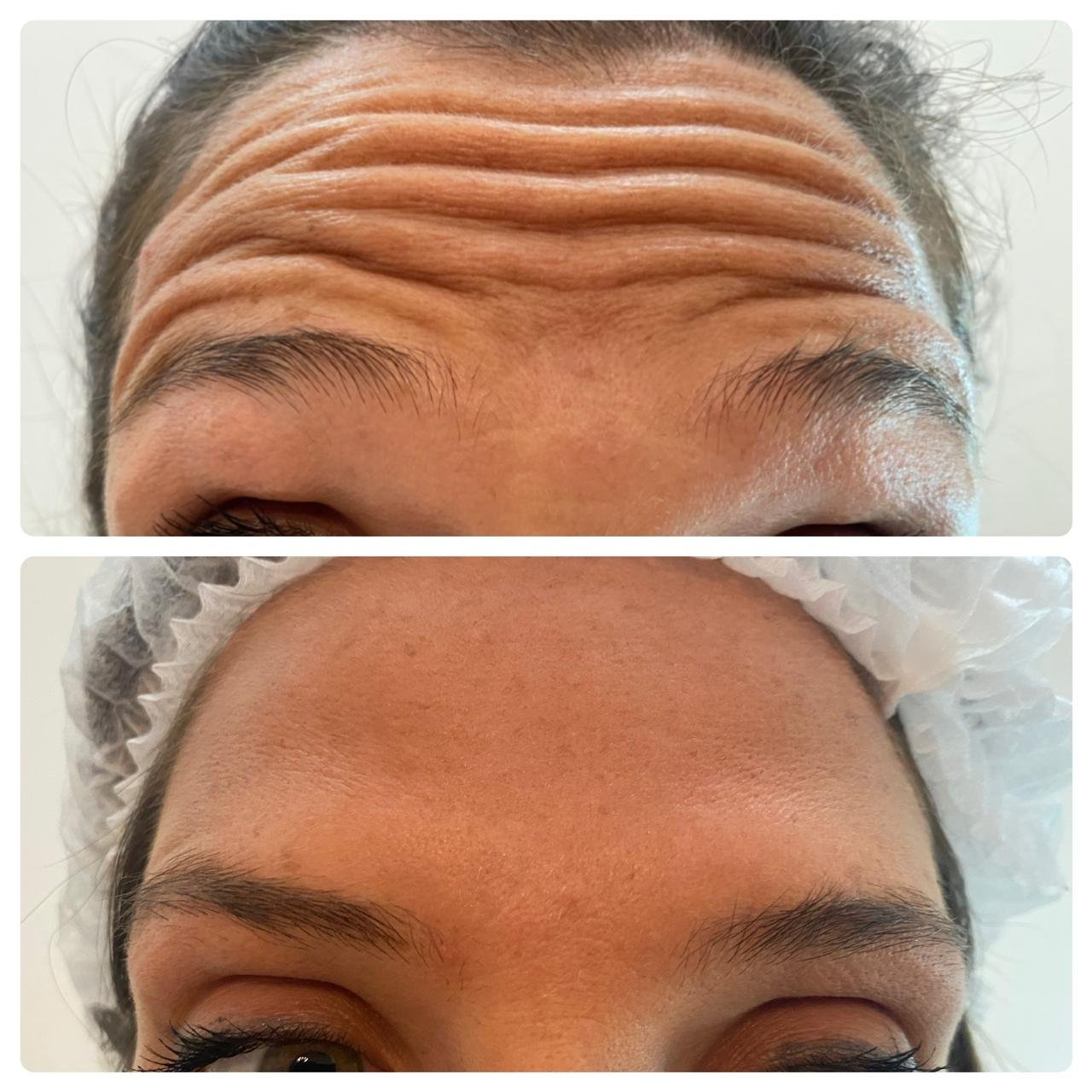 Tratamiento de arrugas frontales