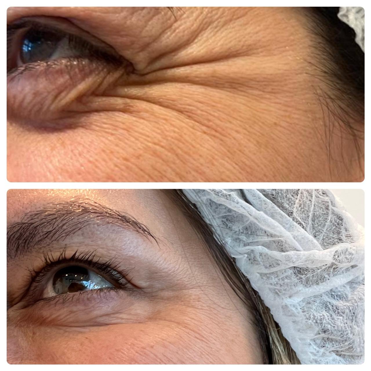 Suavizado de arrugas periorbitarias