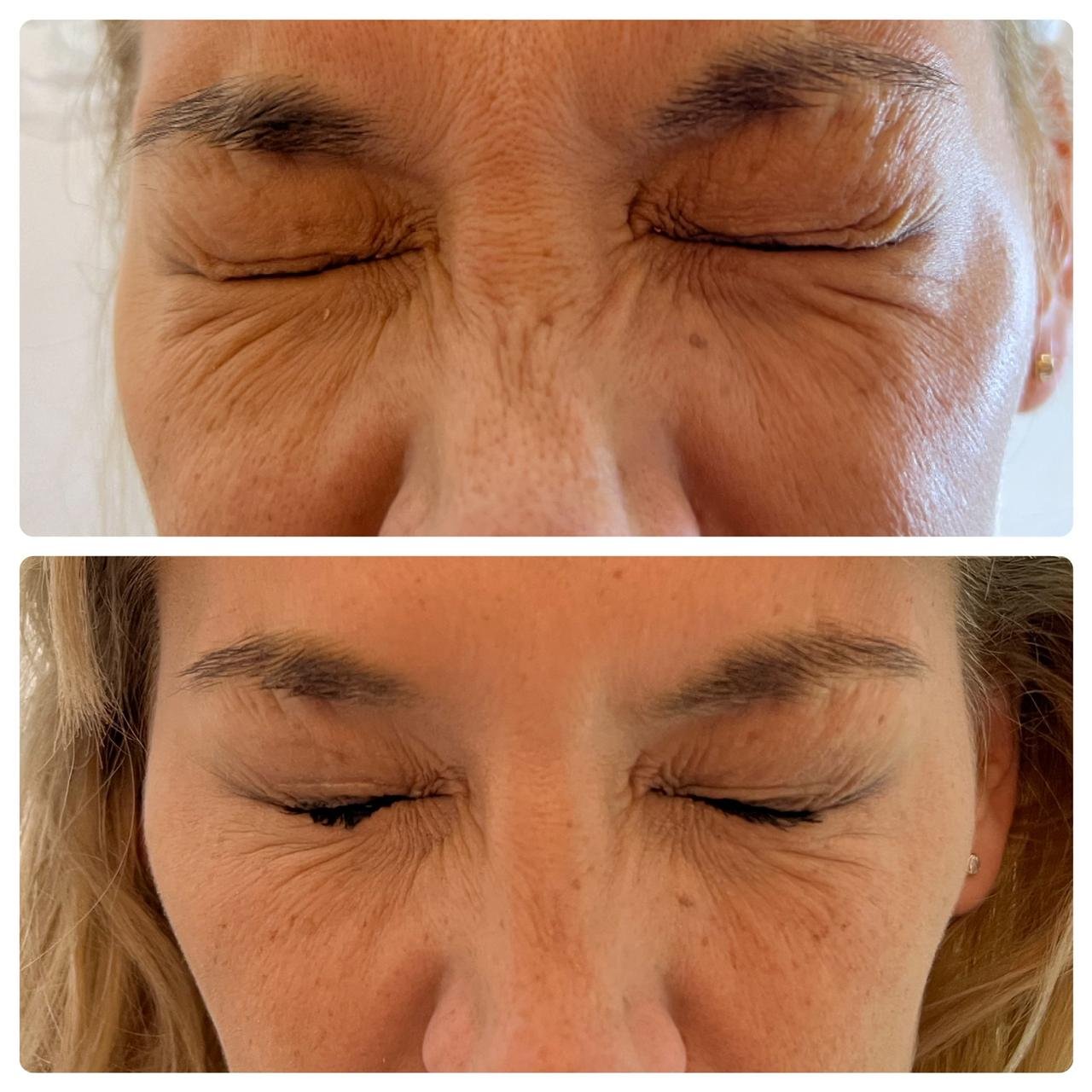 Tratamiento de líneas de conejo