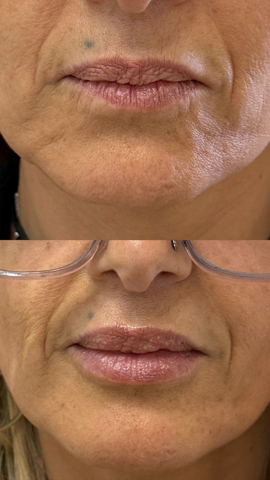 Rejuvenecimiento labial antes y después