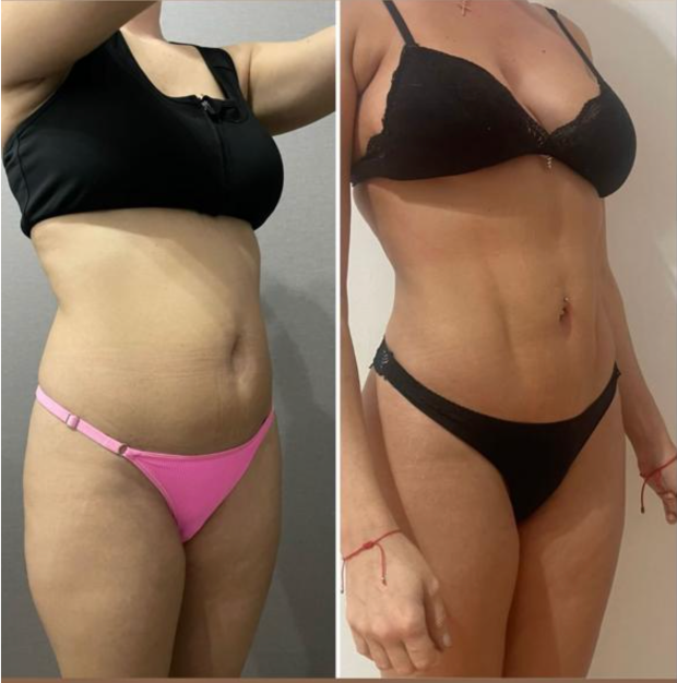 Lipoescultura 360 grados antes y después Buenos Aires