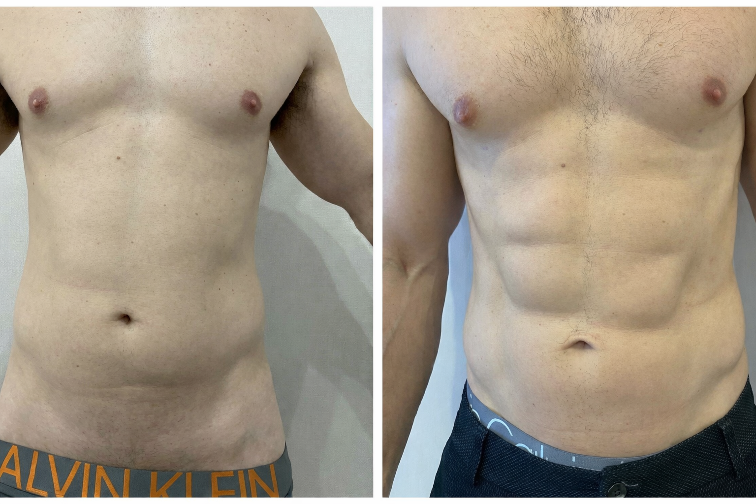Lipomarcación abdominal hombres six pack