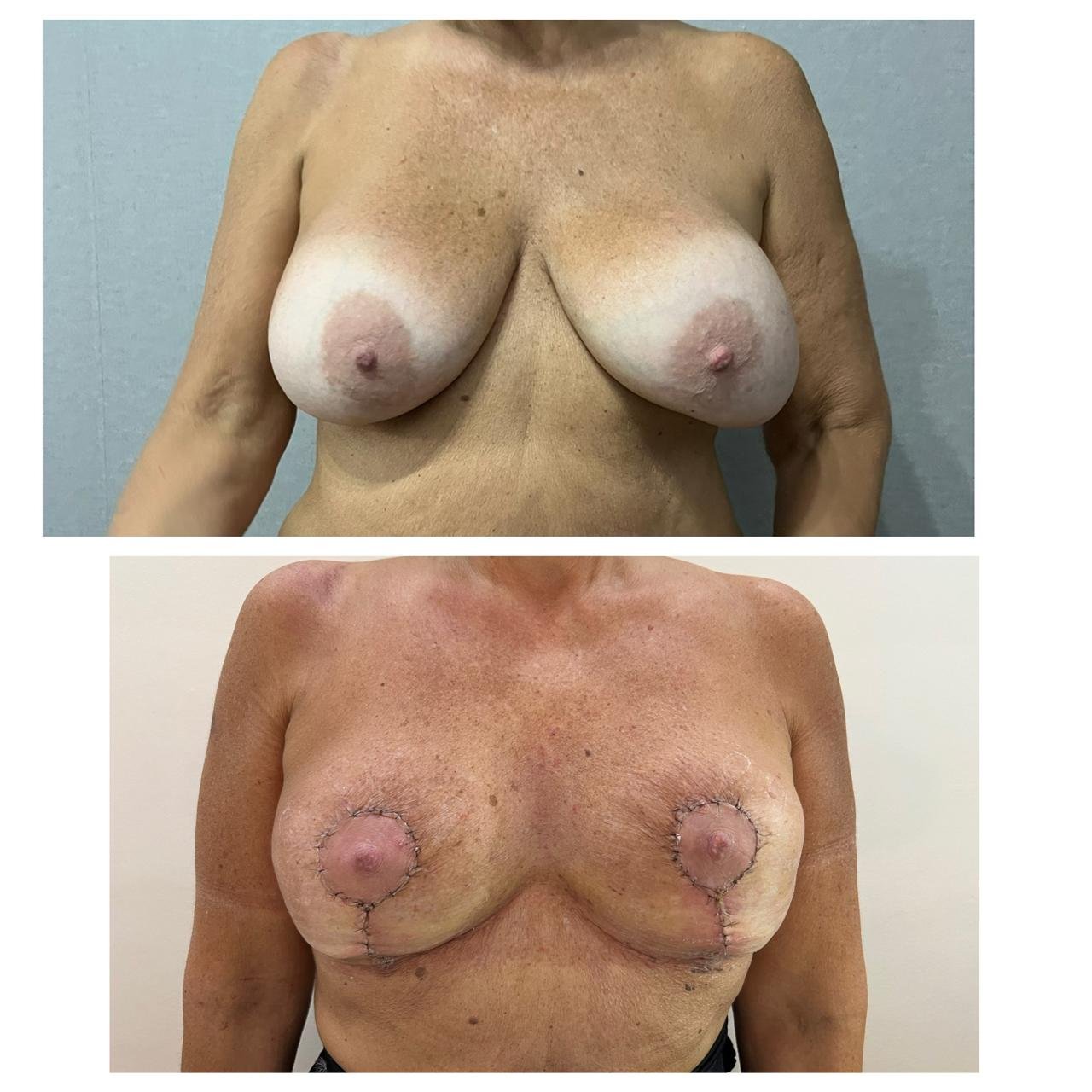 Retiro de implantes + Mastopexia antes y despues