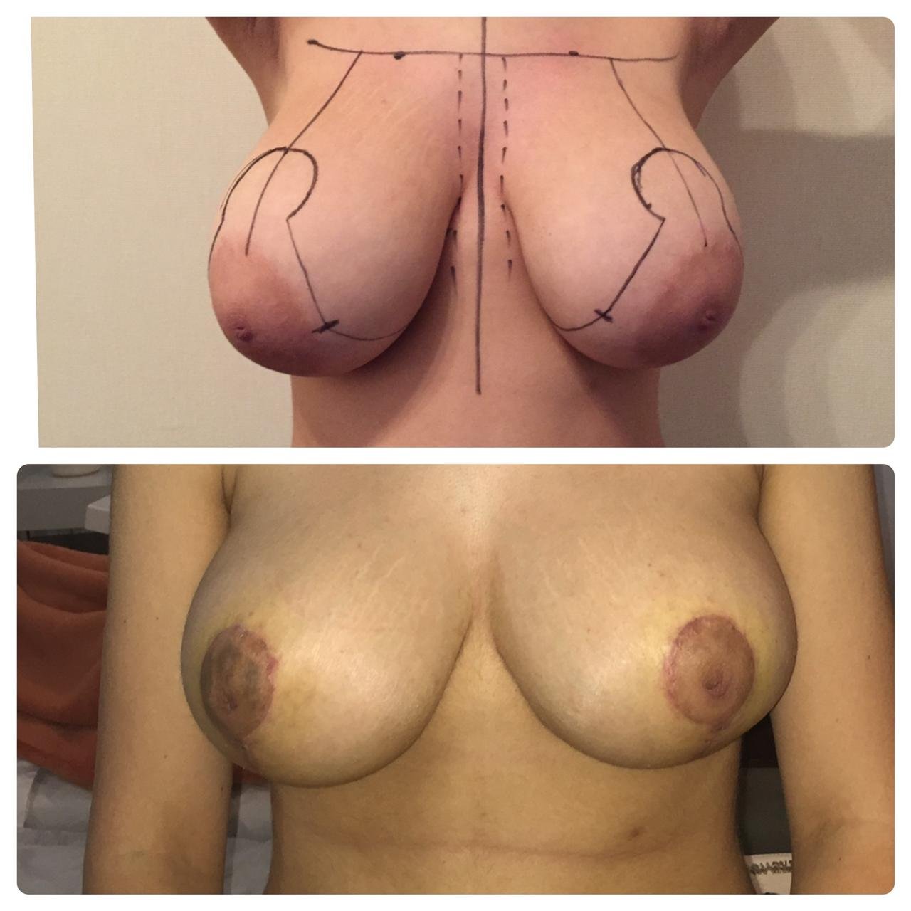 Reducción Mamaria Antes y Después