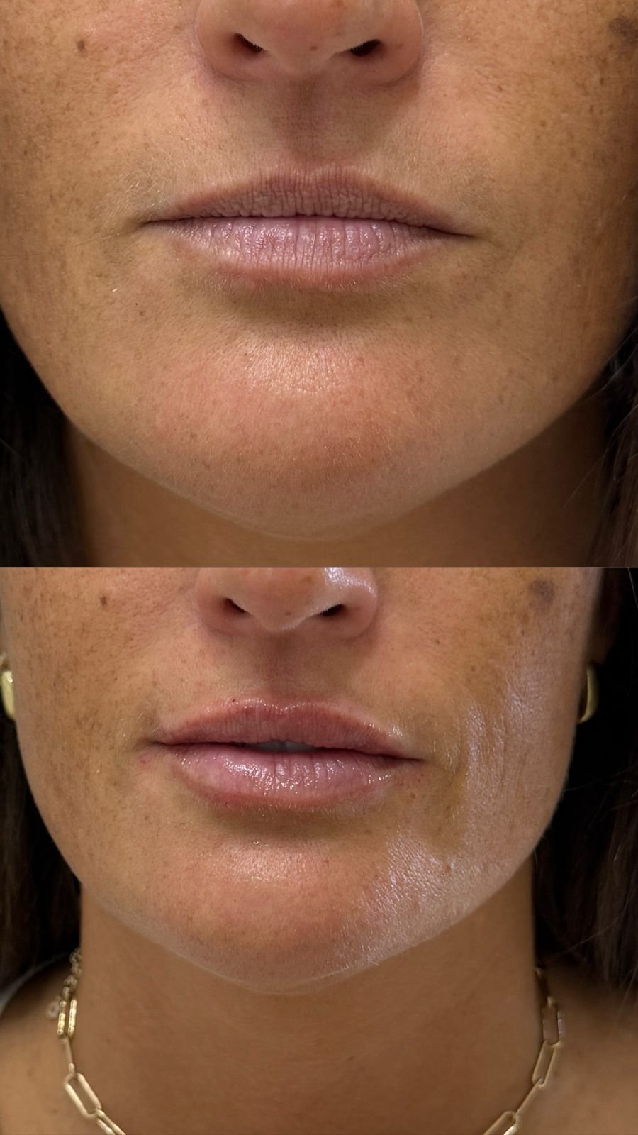 Volumen estructural con ácido hialurónico