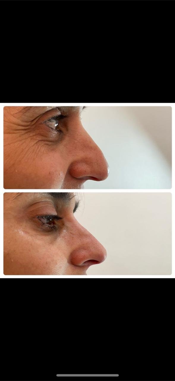 Rinoplastia con efecto de rejuvenecimiento facial