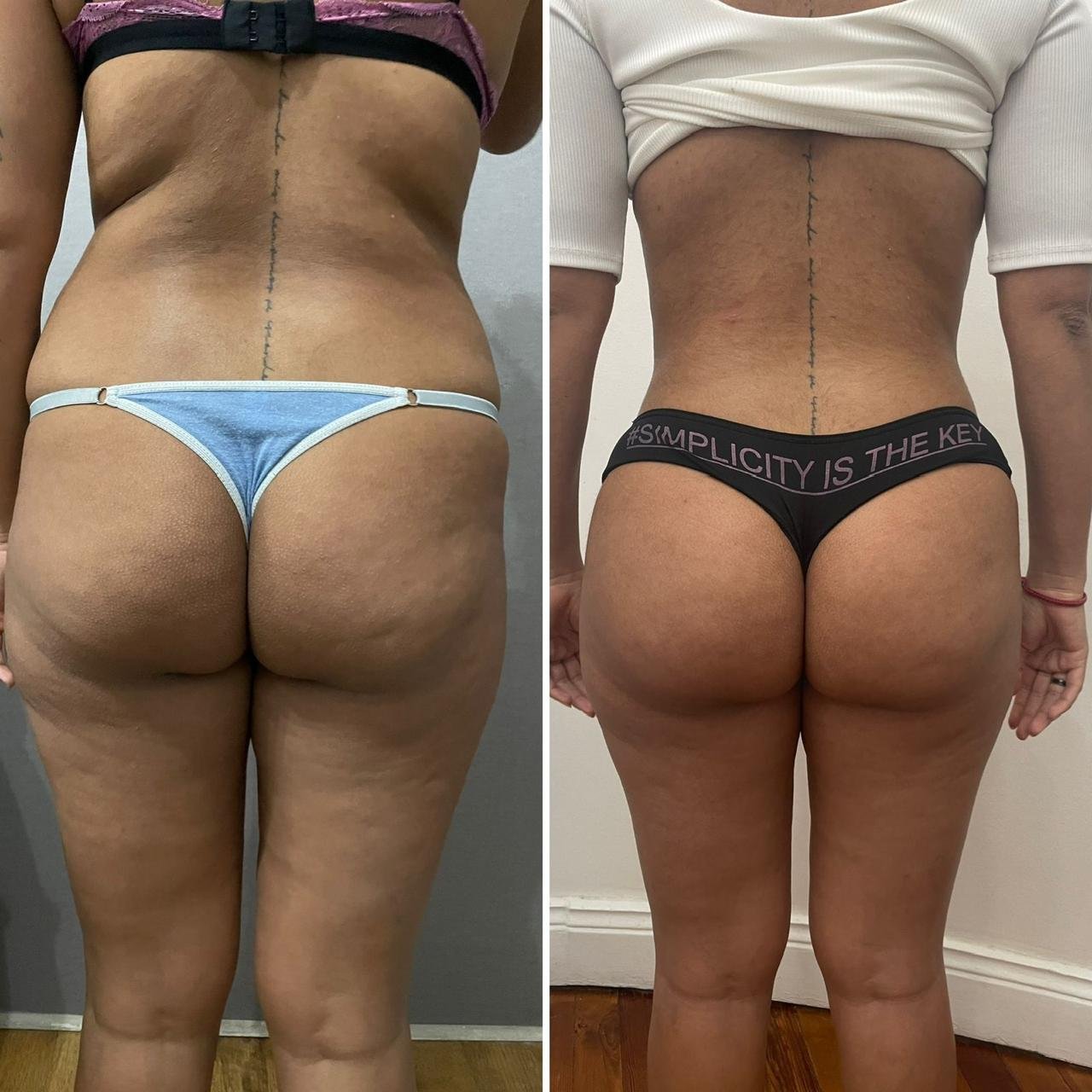 Caso 1 Antes y Después