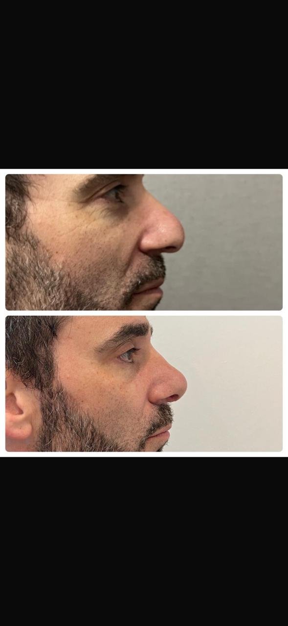 Rinoplastia masculina con dorso recto